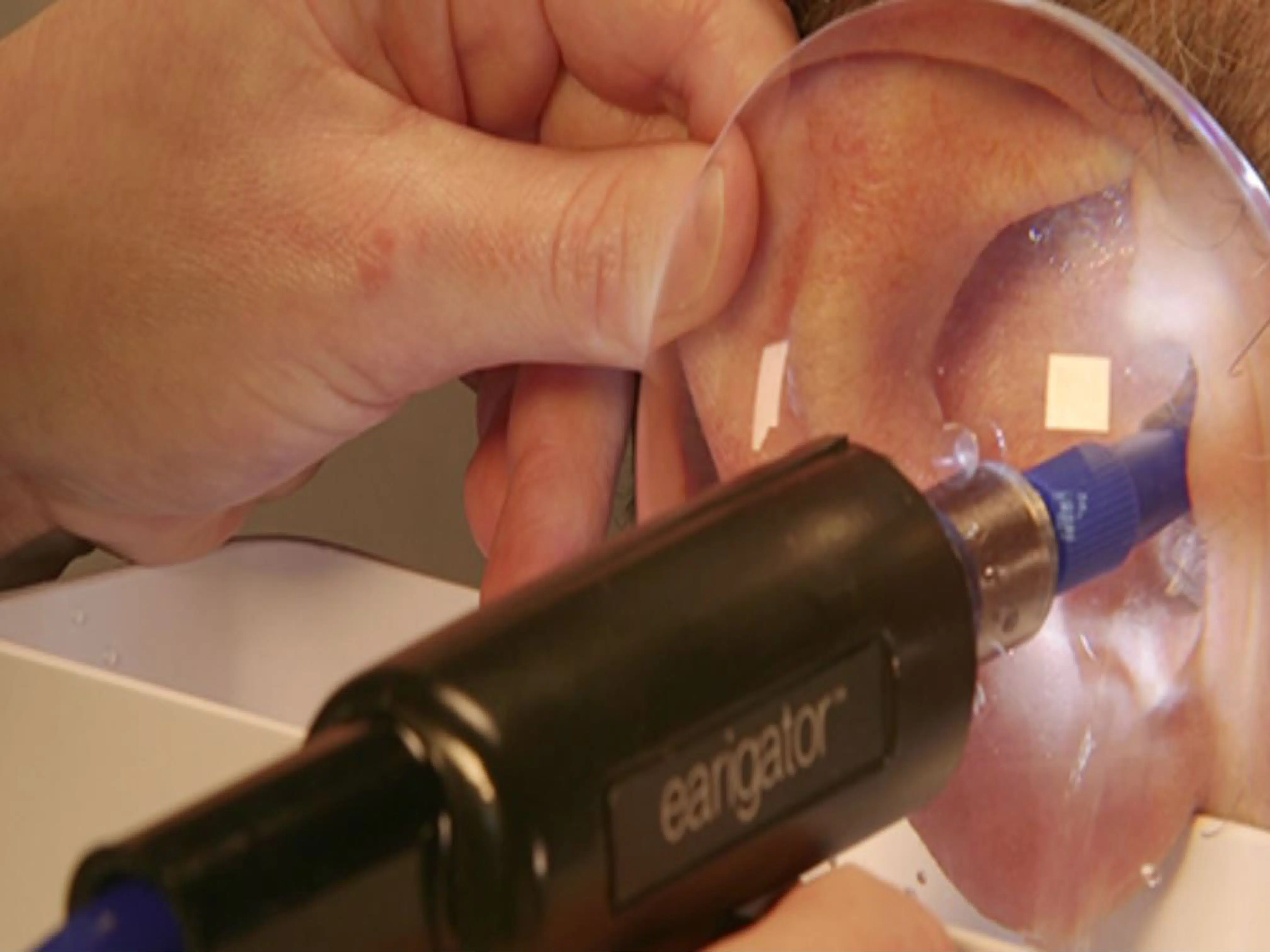 Audiologist Removing Earwax with Earigator